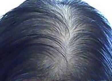脂溢性脱发有哪些分类?